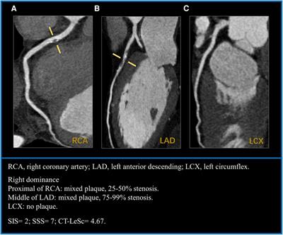 Type 2 diabetes mellitus aggravates coronary atherosclerosis in hypertensive individuals based on coronary CT angiography: a retrospective propensity score-based study